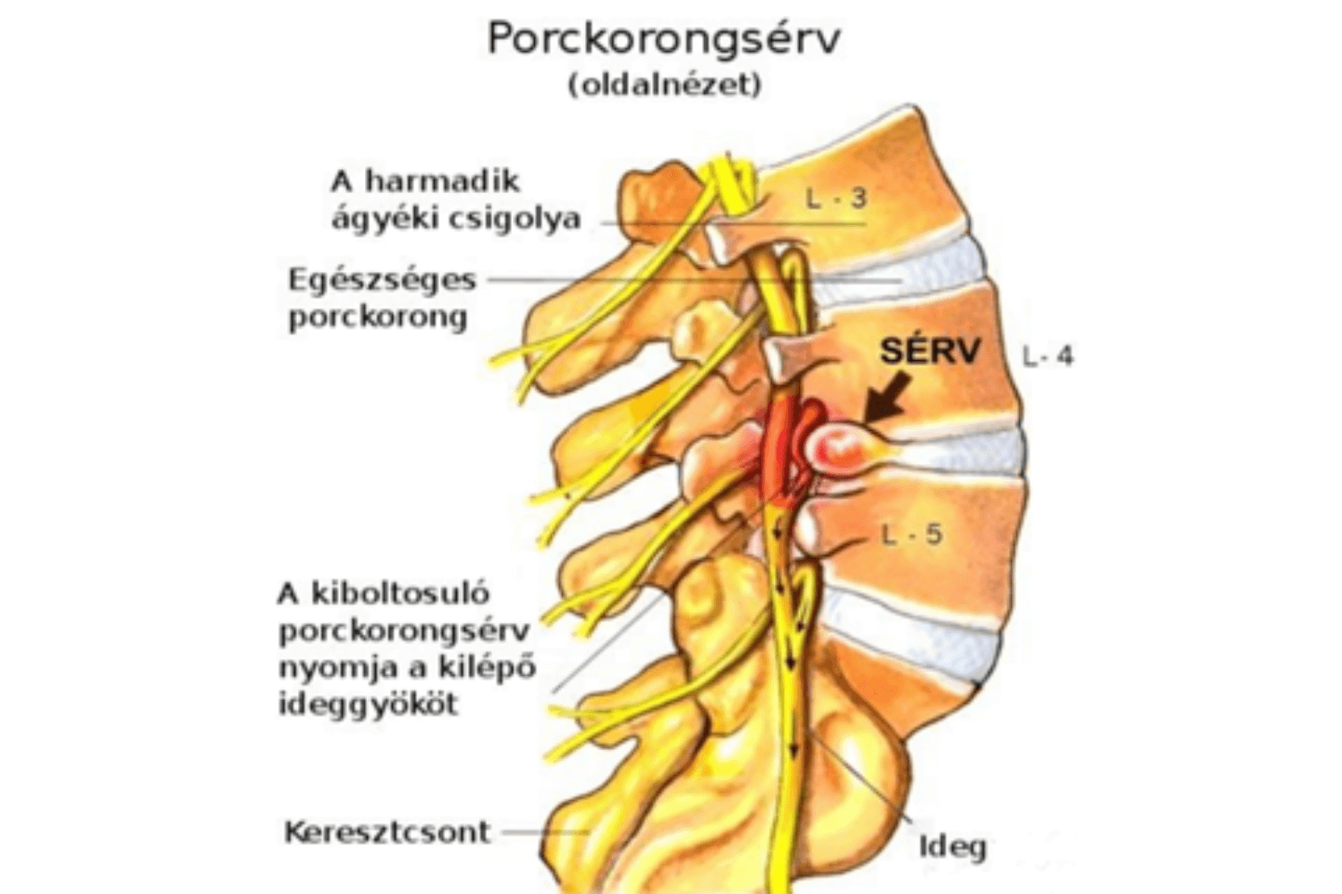 Porckorongsérv, testtartásjavító tréning és gerinctorna Budapest, Győr.